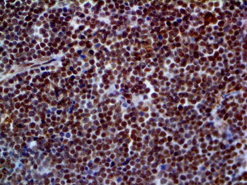 IHC of ERCC1 on an FFPE Lymphoblastic Lymphoma Tissue